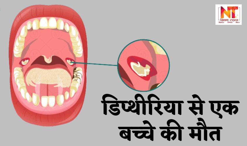 Diphtheria